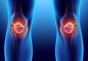 Wenn Geräusche aus Ihrem Knie kommen, kann dies ein Zeichen für einen Meniskusriss sein