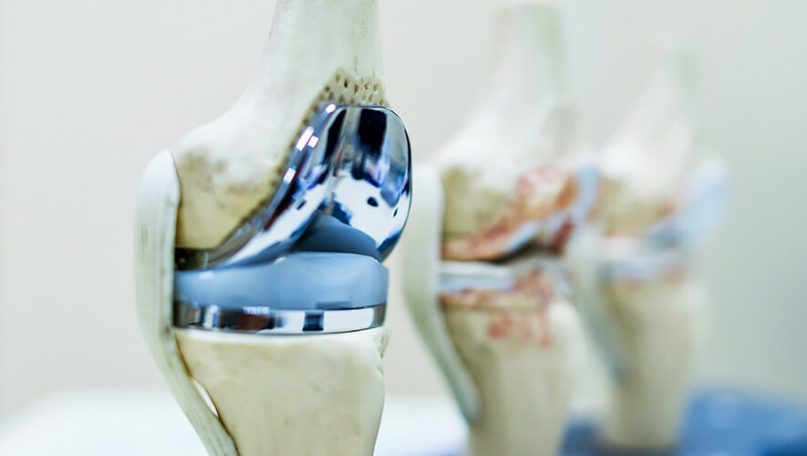 Knee Replacement