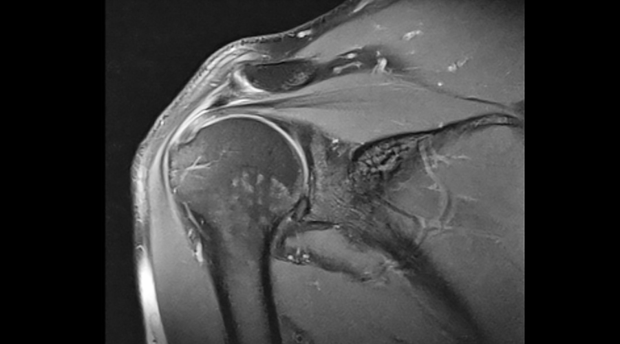 Omuz Sıkışma Sendromu