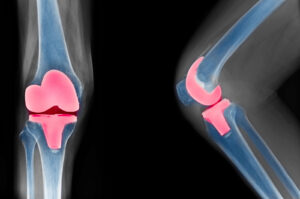 Knee Replacement Surgery