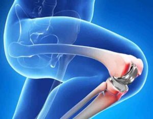 Knee Replacement Surgery