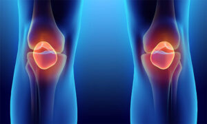 Хирургия артрита коленного сустава