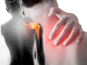 Синдром замороженного плеча 