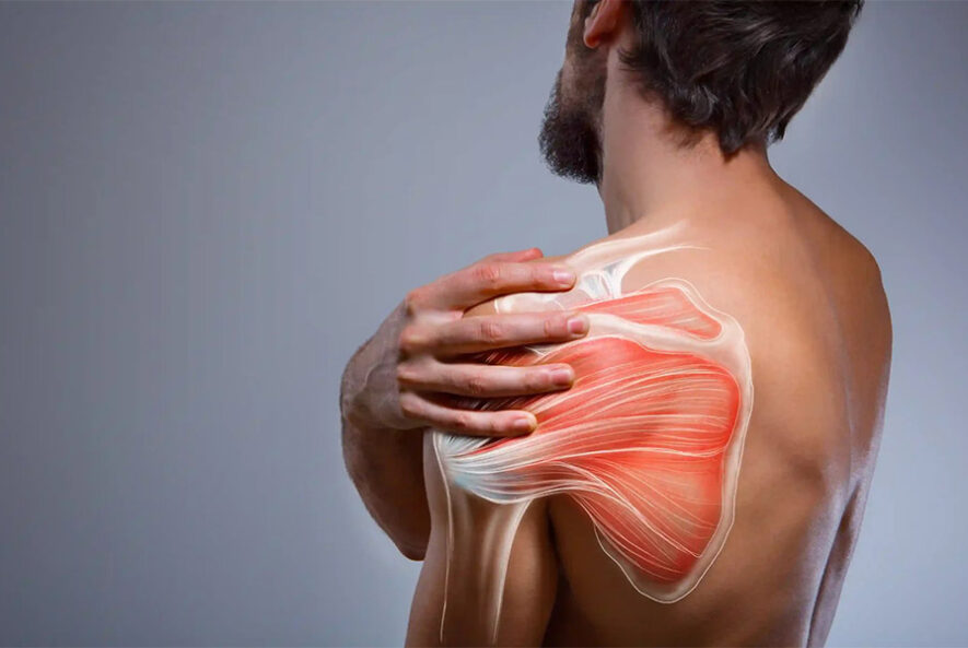 Что такое синдром импинджмента плеча?