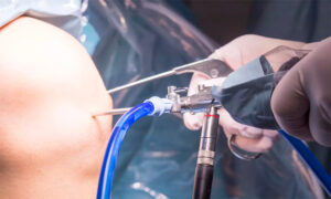 What is Arthroscopic Surgery?