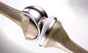 Preise für Knieersatz