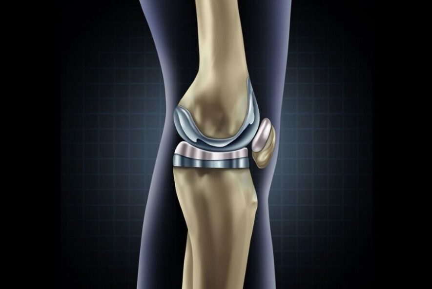 Preise für Knieersatz