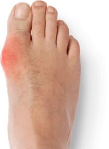 Ursachen, Symptome und Behandlungsmethoden der Gichterkrankung