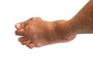 Ursachen und Behandlungsmethoden der Gichterkrankung