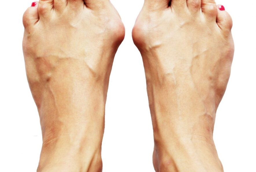 Ursachen, Symptome und Behandlungsmethoden der Gichterkrankung