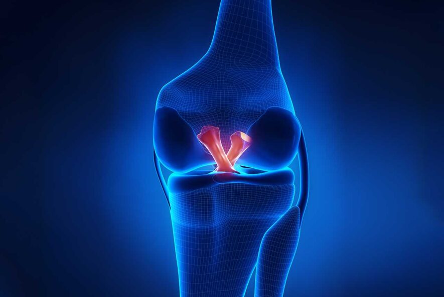 Anterior Cruciate Ligament Tear Symptoms, Causes and Treatment Options