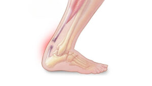 Achilles Tendon Rupture 