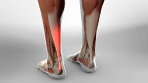 Achilles Tendon Rupture 