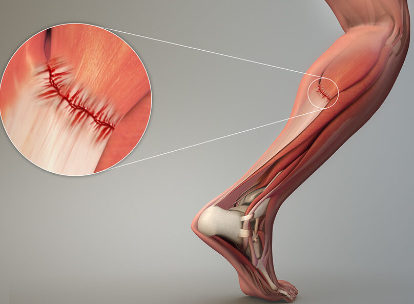Achilles Tendon Rupture