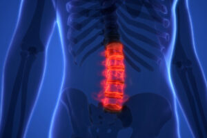 Перелом позвоночника