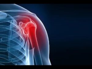 Rotator Cuff Tear 