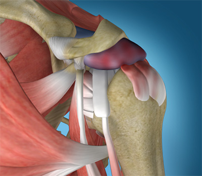 Rotator Cuff Tear