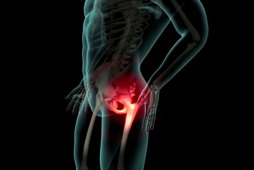 Hüftersatzoperation